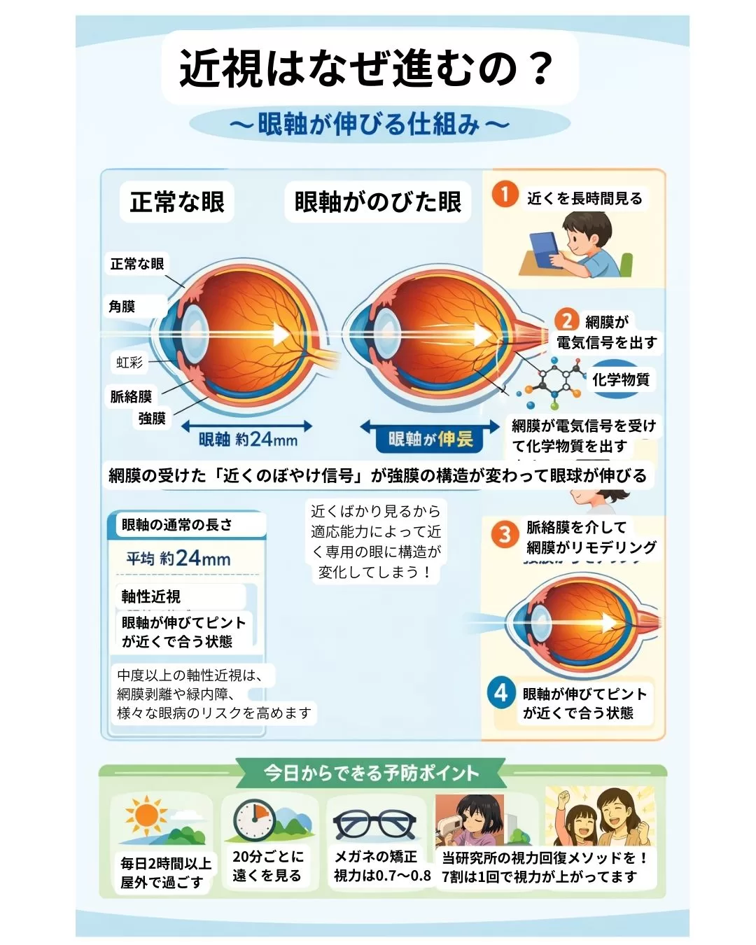 近視が進むメカニズムを解説　